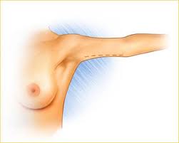 chirurgie esthétique bras