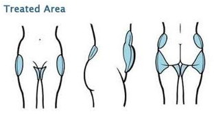 Coolsculpting resultats Coolsculpting résultats