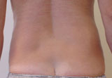 Patiente après un traitement par coolsculpting sur chaque hanche : silhouette affinée