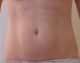 Patiente après un traitement par coolsculpting sur chaque hanche : silhouette affinée