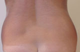 Patiente avant cryolipolyse des hanches