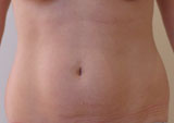 Patiente avant cryolipolyse des hanches