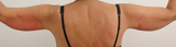 Photos avant séance de Cryolipolyse des bras