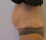 Patiente présentant une surcharge graisseuse abdominale, avant Coolsculpting