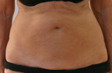 Patiente 4 mois après 2 séances de Coolsculpting