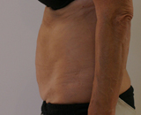 Patiente 4 mois après 2 séances de cooosculpting au niveau du ventre