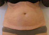 Patiente avant Coolsculpting