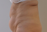 Patiente avant Cryolipolyse