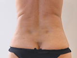 Après séances de Coolsculpting (cyolipolyse) des hanches