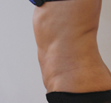 Après séances de Coolsculpting (cryolipolyse) abdominal