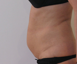 Avant séances de Coolsculpting abdominal