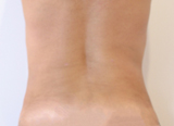 Après 1 séance de Coolsculpting sur chaque hanche