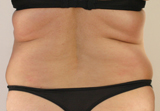 Patiente avant Coolsculpting des poignées d'amour