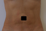 Après cryolipolyse