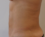 Après séances de Coolsculpting Abdominal sus et sous ombilical