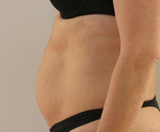 Patiente avant séances de cryolipolyse abdominale