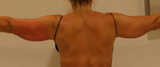 Patiente avant séances de cryolipolyse des bras