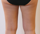 6 mois après une séance de Coolsculpting au niveau de chaque face interne de cuisse.