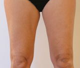 6 mois après une séance de Coolsculpting au niveau de chaque face interne de cuisse.