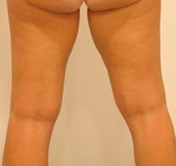 Patiente avant cryolipolyse des cuisses