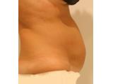 Avant cryolipolyse abdominale