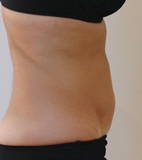 Patiente après Coolsculpting du ventre à Marseille par le docteur Albertine Marchadier