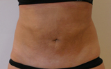 Patiente 6 mois après traitement par Coolsculpting au niveau des hanches
