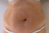 Photos avant traitement par Coolsculpting de Zeltiq