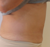 Photos après une séance de Coolsculpting abdominal sus ombilical et une séance sous ombilical