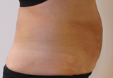 Photos avant séances de Cryolipolyse du ventre par Coolsculpting de Zeltiq