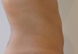 Patiente après une séance de Coolsculpting par Zeltiq sur le ventre au dessus et au dessous du nombril