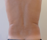 Liposuccion douce