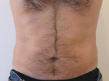 Patient 3 mois après 4 séances de Coolsculpting par le docteur Marchadier à Marseille