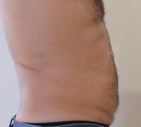 Patient 3 mois après 4 séances de Coolsculpting par le docteur Marchadier à Marseille
