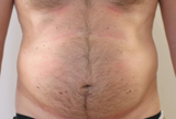 Patient avant séances de cryolipolyse abdominale