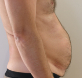 Patient avant séances de cryolipolyse abdominale