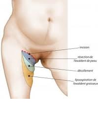 Lifting des cuisses