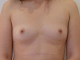 Photo avant chirurgie pour augmentation mammaire par implants mammaires anatomiques