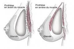 prothèses mamaires augmentation