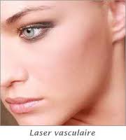 Laser vasculaire du visage
