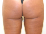 Apres lipoaspiration