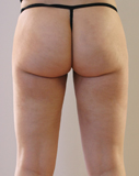 Après lipoaspiration