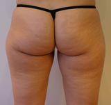 avant lipoaspiration