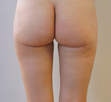 Après chirurgie