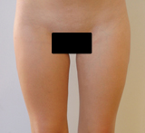 Après chirurgie : liposuccion de la culotte de cheval