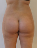 Photos de la patiente après liposuccion de la silhouette