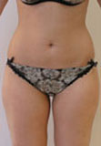 Lipoaspiration