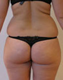 Lipoaspiration