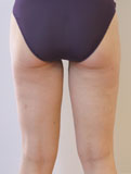 Après lipoaspiration des cuisses et des genoux