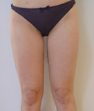 Après lipoaspiration des cuisses et des genoux